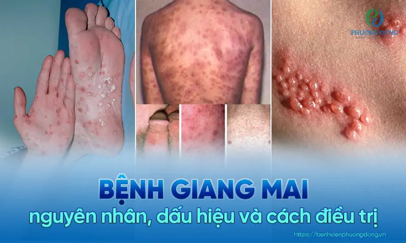 benh-giang-mai.jpg