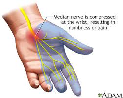Carpal tunnel syndrome Information | Mount Sinai - New York
